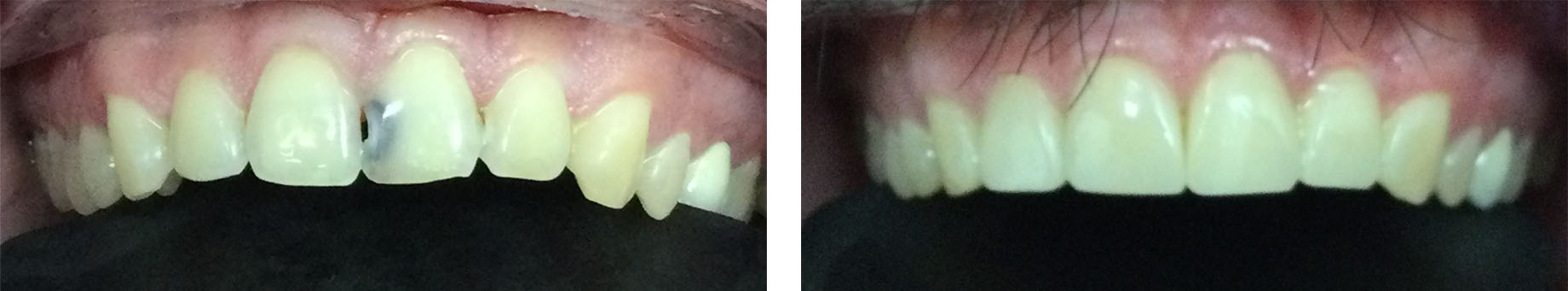 Before and After Photo - Cavity repair