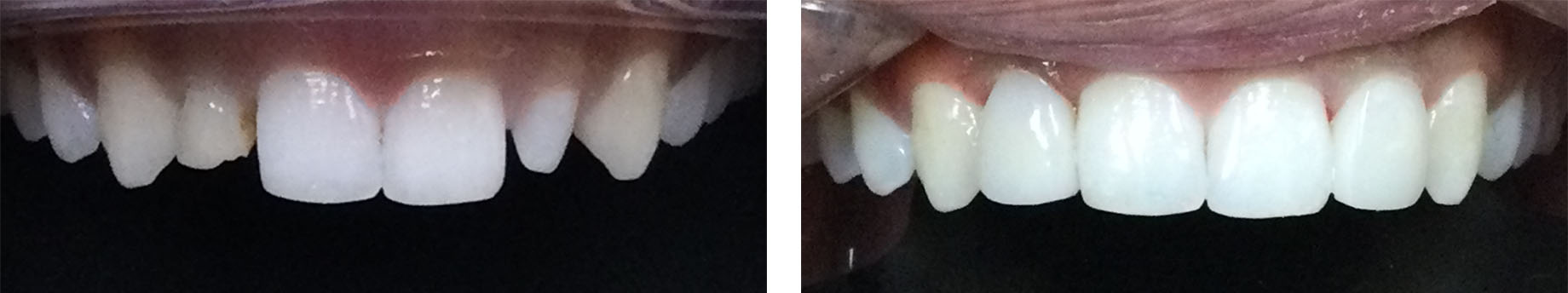 Before and After Photo - Change the tooth size and shape to create a balanced and desired smile