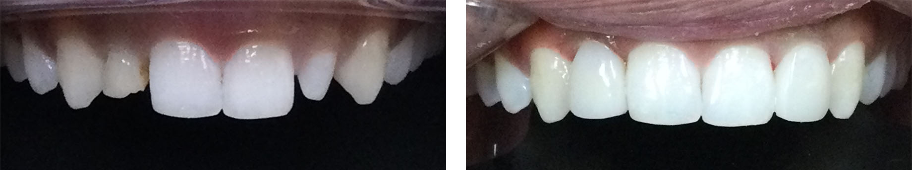 Before and After Photo - Change the tooth size and shape to create a balanced and desired smile