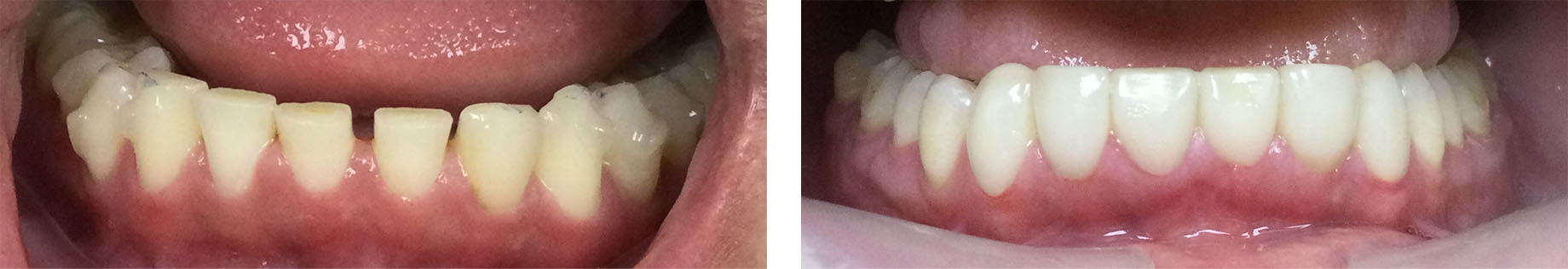 Before and After Photo - Diastema closure